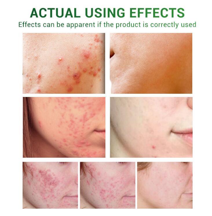 Acne Treatment Serum Facial Repair Oil - AXON